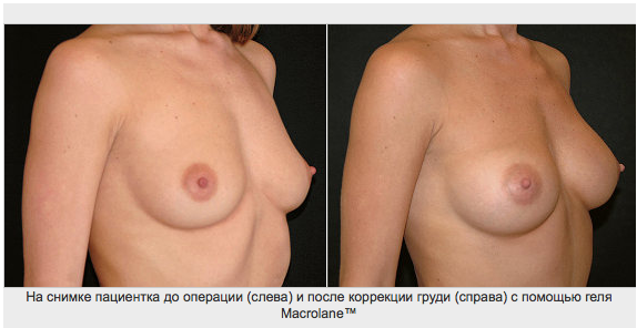 фото: результат увеличения груди гелем Макролайн