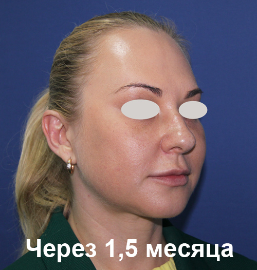 фото через 1,5 месяца после подтяжки лица нитями фото через 1,5 месяца после подтяжки лица нитями