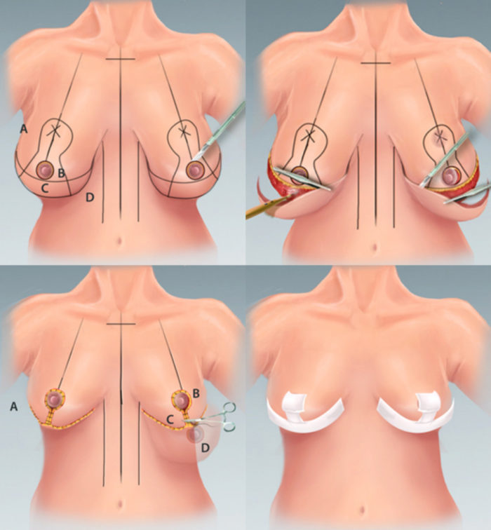 схема подтяжки груди