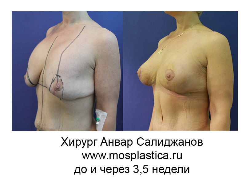 фото до и после подтяжки груди на имплантах 3,5 недели (хирург Салиджанов Анвар)