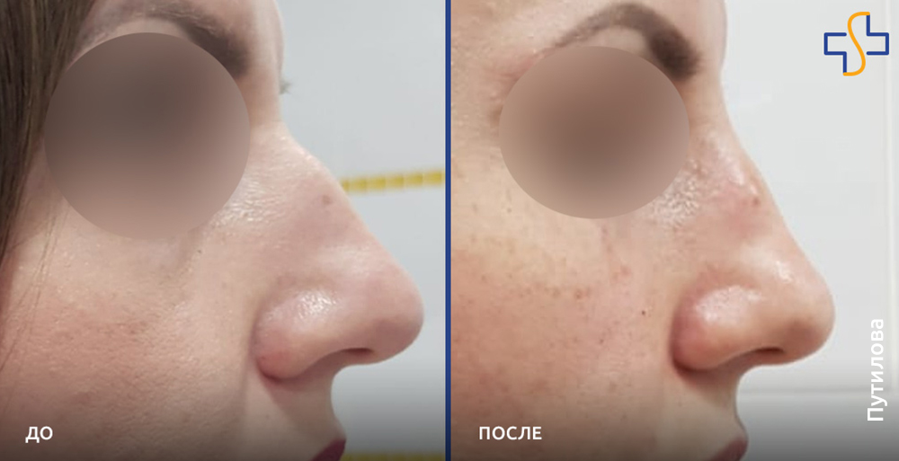 фото до и после: коррекция носа без операции, совмещенная с подтяжкой лица нитями Аптос