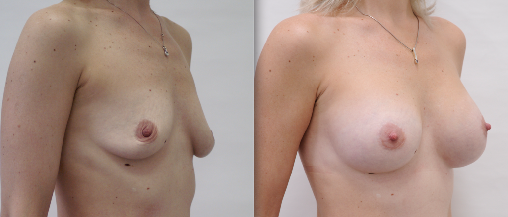 подтяжка груди после родов. грудь после родов. фото до и после, хирург Салиджанов А.Ш. 2