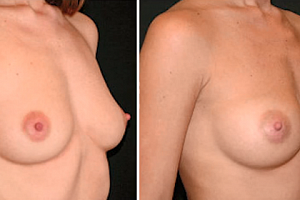 Липофилинг груди (увеличение груди макролайном)