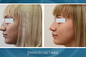 Круговая блефаропластика в сочетании с пластикой кончика носа: симультанная операция